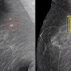 Illustration for article titled Google's AI Proves Better at Detecting Breast Cancer Than Doctors